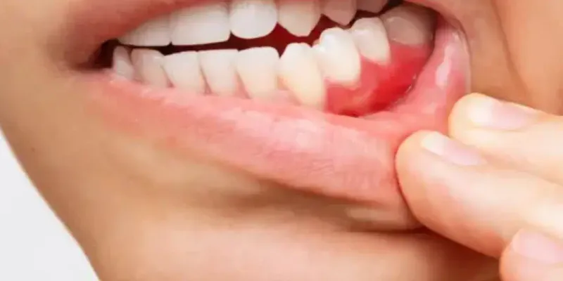 Gingivitis Clínica Dental Cholula Puebla