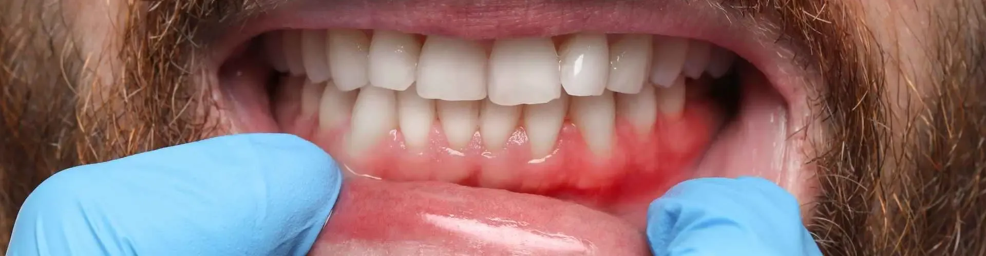 Gingivitis Clínica Dental Cholula Puebla